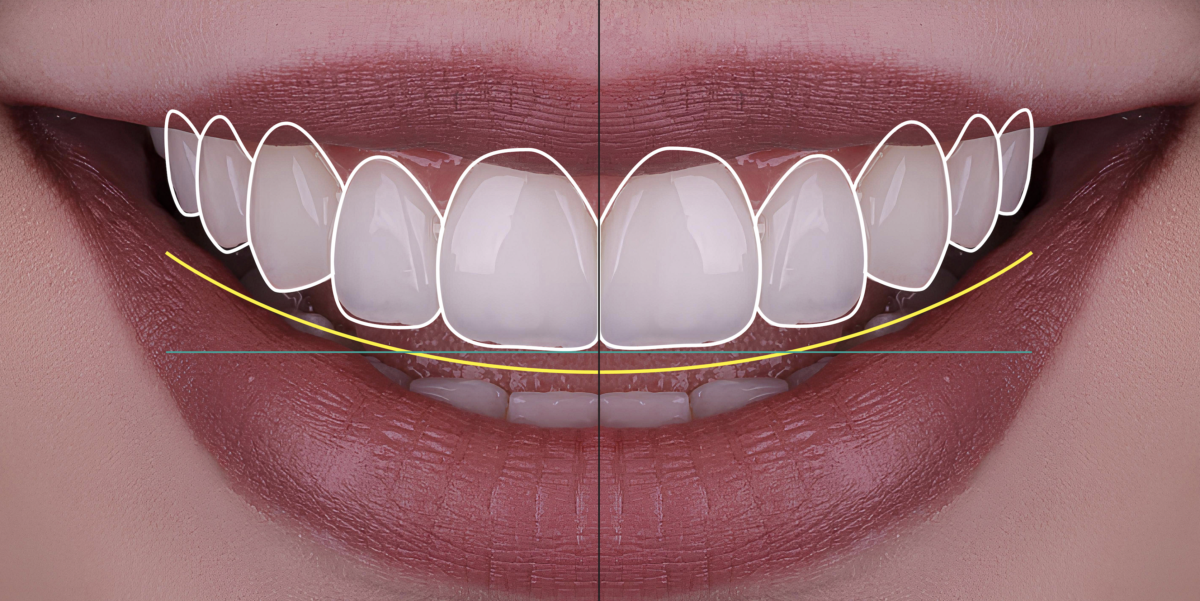 Smile Makeover