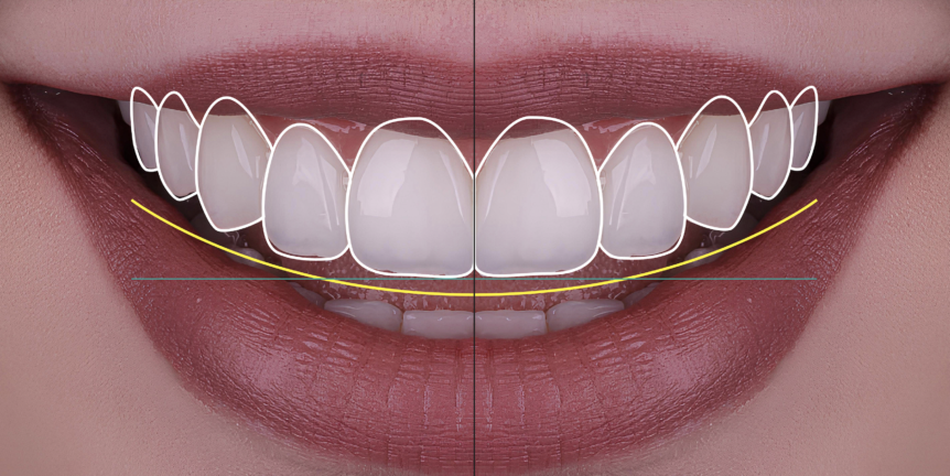 Smile Makeover